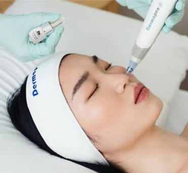 Dermapen/Mikroneedling m/Exosomer